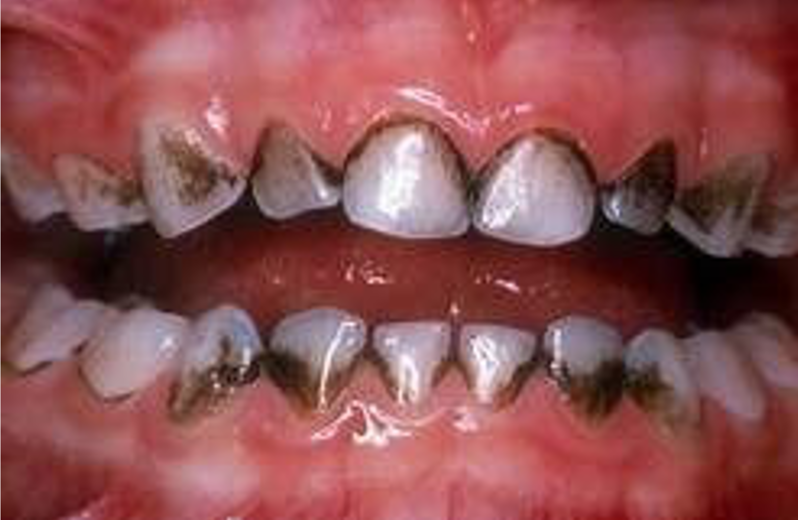 Τερηδόνα σε παιδικά δόντια