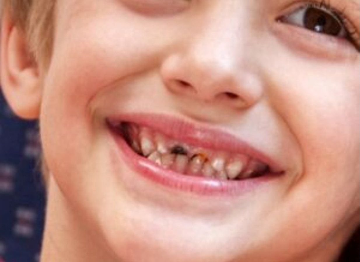 Τερηδόνα σε παιδικά δόντια