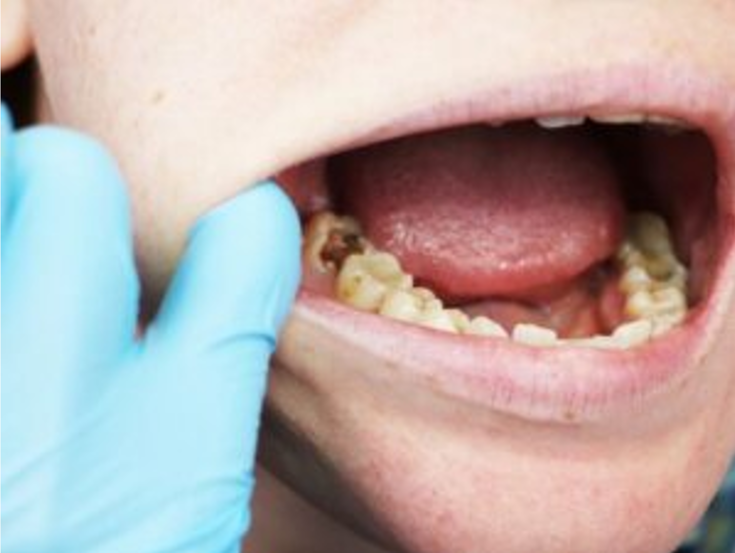 Τερηδόνα σε παιδικά δόντια