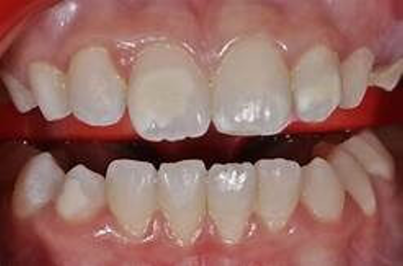 Τερηδόνα σε παιδικά δόντια